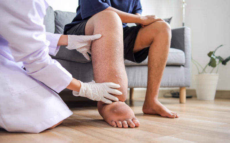 Filariasis in Indonesia