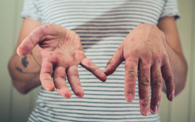 Hand, Foot and Mouth Disease